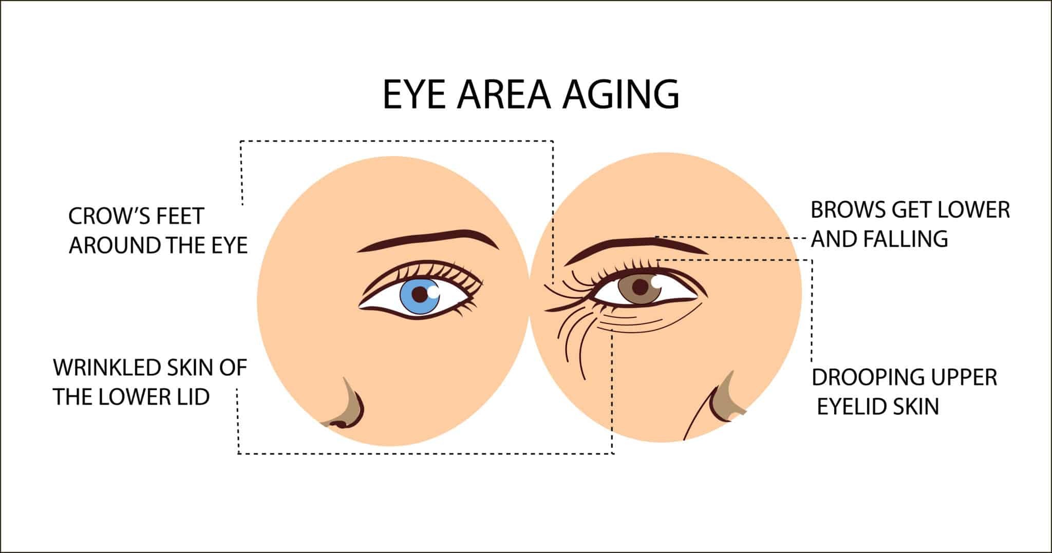 Other Method for Reducing Under Eye Wrinkles